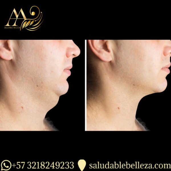 Lipopapada o liposucción submandibular, Eliminación de grasa submentoniana. Definición y marcación de reborde y ángulo mandibular.