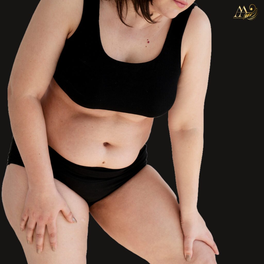 Abdominoplastia en Medellín y Bogotá, elimina el exceso de piel y grasa del abdomen, creando un contorno más delgado y definido.