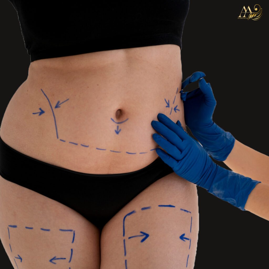 Abdominoplastia y Liposucción 360 + Lipotransferencia: eliminar el exceso de piel y grasa no deseada para realzar tus curvas naturales.
