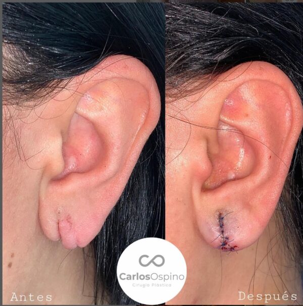 La lobuloplastia en Medellín, es un procedimiento que corrige los lobulos de las orejas grandes, alargados o rasgados. Con anestesia local y poco invasivo.