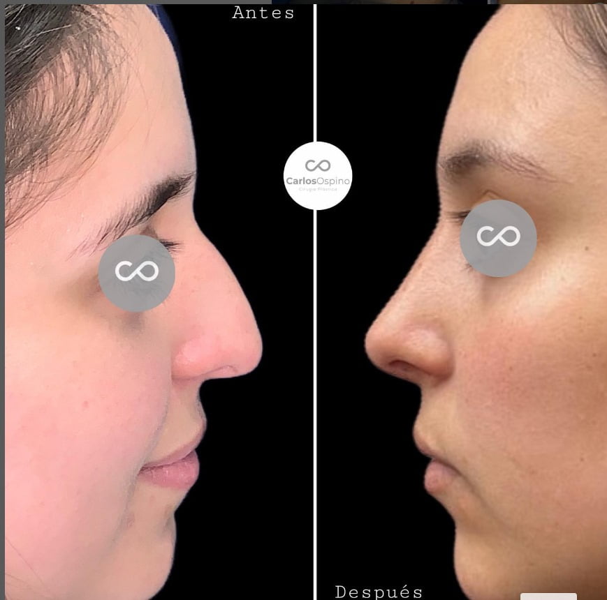 la Rinoplastia en Medellín y Bogotá. La belleza no tiene límites. Descubre tu mejor versión y siéntete seguro y radiante en tu propia piel.