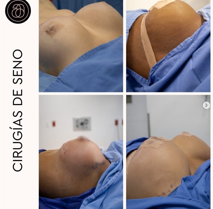 Mastopexia con y sin implantes en Medellín