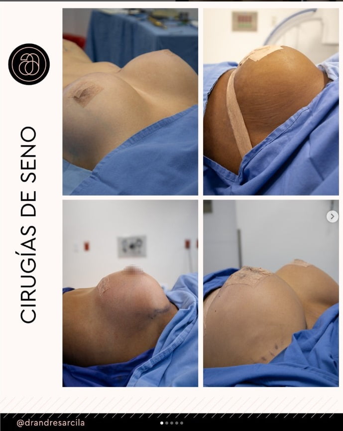 Mastopexia con y sin implantes en Medellín. La belleza viene en todas las formas y tamaños. Incluida la apariencia y la firmeza de sus senos